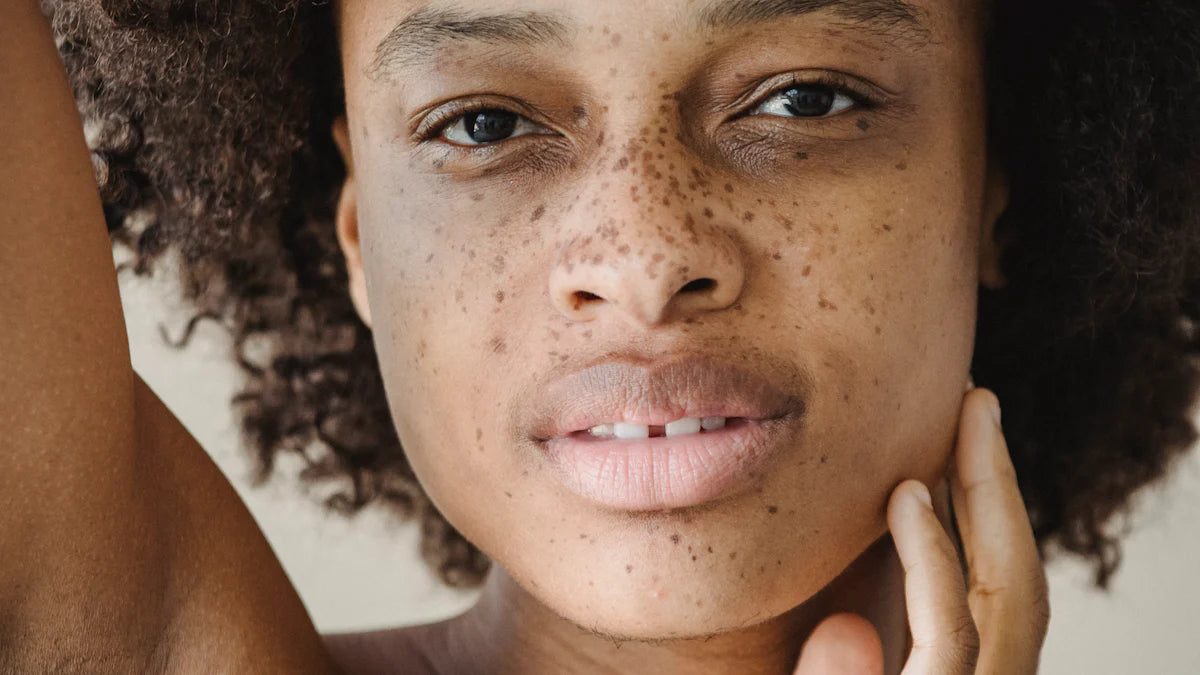 そばかすとシミの違いを徹底解説しながら予防策を学ぶ